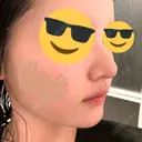 鼻尖形成（切開） / 小鼻縮小（切開） / 軟骨移植 / 鼻柱下降・鼻唇角形成（猫手術） / ボトックス（エラ・小顔） ASTRA BEAUTY CLINIC DAY 23 サムネイル用