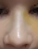 隆鼻術 / 鼻尖形成（切開） / 鼻中隔延長（切開） / その他（輪郭） リッツ美容外科 東京院 DAY 8 サムネイル用