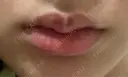 ヒアルロン酸注入（唇） 目白ホワイトクリニック DAY 3 サムネイル用
