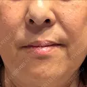 レーザートーニング（美白・肝斑） トラスト美容クリニック 銀座院 DAY 1 サムネイル用