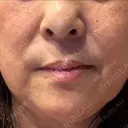 レーザートーニング（美白・肝斑） トラスト美容クリニック 銀座院 DAY 2 サムネイル用