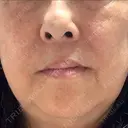 レーザートーニング（美白・肝斑） トラスト美容クリニック 銀座院 DAY 3 サムネイル用