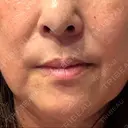 レーザートーニング（美白・肝斑） トラスト美容クリニック 銀座院 DAY 4 サムネイル用