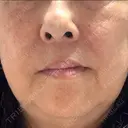 レーザートーニング（美白・肝斑） トラスト美容クリニック 銀座院 DAY 5 サムネイル用