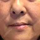 レーザートーニング（美白・肝斑） トラスト美容クリニック 銀座院 DAY 6 サムネイル用