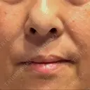 レーザートーニング（美白・肝斑） トラスト美容クリニック 銀座院 DAY 7 サムネイル用