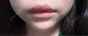 ボトックス（口角） AURORA CLINIC（オーロラクリニック）新宿院 DAY 0 サムネイル用