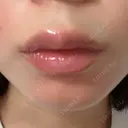 ヒアルロン酸注入（唇） 目白ホワイトクリニック AFTER サムネイル用