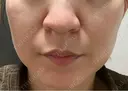 ピコレーザートーニング（美白・肝斑） / フラクショナルレーザー（毛穴・ニキビ跡） ルラ美容クリニック 横浜院 DAY 5 サムネイル用