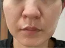 ピコレーザートーニング（美白・肝斑） / フラクショナルレーザー（毛穴・ニキビ跡） ルラ美容クリニック 横浜院 DAY 6 サムネイル用