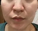 ピコレーザートーニング（美白・肝斑） / フラクショナルレーザー（毛穴・ニキビ跡） ルラ美容クリニック 横浜院 DAY 7 サムネイル用