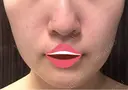 脂肪吸引（顔） 湘南美容クリニック 渋谷院 DAY 74 サムネイル用