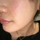 肌育注射（ジュベルックなど） / イオン導入 / ピーリング（ハリ・ツヤ） ゆう美容クリニック DAY 0 サムネイル用