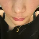 肌育注射（ジュベルックなど） / イオン導入 / ピーリング（ハリ・ツヤ） ゆう美容クリニック DAY 0 サムネイル用