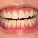 矯正（マウスピース） 湘南歯科クリニック 池袋院 DAY 47 サムネイル用