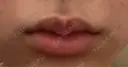 ヒアルロン酸注入（唇） 目白ホワイトクリニック DAY 5 サムネイル用
