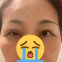 二重切開 水の森美容クリニック 大阪梅田院 AFTER サムネイル用