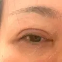 二重切開 水の森美容クリニック 大阪梅田院 DAY 39 サムネイル用