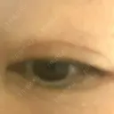 二重切開 水の森美容クリニック 大阪梅田院 DAY 39 サムネイル用