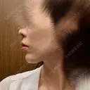 ボトックス（あご） / 肌ヒアルロン酸注入（たるみ・シワ改善） plume clinic AFTER サムネイル用