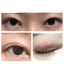 二重切開 表参道スキンクリニック 表参道院 DAY 84 サムネイル用