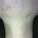 ハイフ（顔） S-Laboクリニック 渋谷院 AFTER サムネイル用