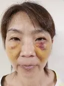 クマ治療 湘南美容クリニック 千葉センシティ院 AFTER サムネイル用