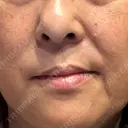 レーザートーニング（美白・肝斑） トラスト美容クリニック 銀座院 DAY 8 サムネイル用