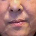 レーザートーニング（美白・肝斑） トラスト美容クリニック 銀座院 AFTER サムネイル用