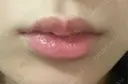 ヒアルロン酸注入（唇） 目白ホワイトクリニック DAY 6 サムネイル用