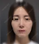 鼻尖縮小 / ヒアルロン酸注入（鼻） 東京ヒルズクリニック 銀座院 DAY 7 サムネイル用