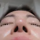 鼻尖縮小 / ヒアルロン酸注入（鼻） 東京ヒルズクリニック 銀座院 DAY 7 サムネイル用