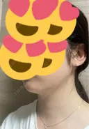 ハイフ（顔） S-Laboクリニック 渋谷院 DAY 0 サムネイル用