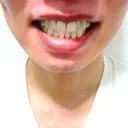 ホワイトニング ビジューデンタルサロン DAY 0 サムネイル用