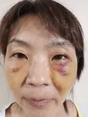クマ治療 湘南美容クリニック 千葉センシティ院 AFTER サムネイル用