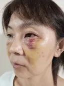 クマ治療 湘南美容クリニック 千葉センシティ院 DAY 7 サムネイル用
