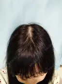 鼻修正 / 切開リフト / 鼻翼基部形成（貴族手術） リッツ美容外科 東京院 DAY 159 サムネイル用