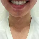 ホワイトニング ビジューデンタルサロン DAY 1 サムネイル用