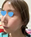 水光注射（ハリ・美肌） ちぐさ内科クリニック 覚王山 DAY 0 サムネイル用