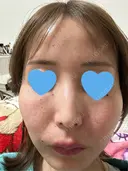 水光注射（ハリ・美肌） ちぐさ内科クリニック 覚王山 DAY 0 サムネイル用