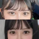 二重埋没 / RF（高周波）たるみ治療 Wing clinic 豊中駅前院 AFTER サムネイル用
