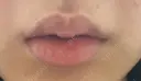 ヒアルロン酸注入（唇） 目白ホワイトクリニック DAY 7 サムネイル用