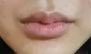 ヒアルロン酸注入（唇） 目白ホワイトクリニック DAY 8 サムネイル用