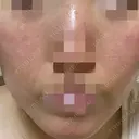 ポテンツァ ルラ美容クリニック 岡山院 DAY 0 サムネイル用