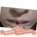 脂肪注入（肌） 広島プルミエクリニック DAY 31 サムネイル用
