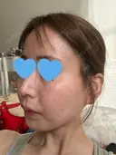 水光注射（ハリ・美肌） ちぐさ内科クリニック 覚王山 AFTER サムネイル用