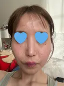 水光注射（ハリ・美肌） ちぐさ内科クリニック 覚王山 DAY 1 サムネイル用