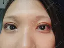 二重切開 / 目頭切開 / 上まぶたたるみ取り アリエル美容クリニック 大宮院 DAY 10 サムネイル用