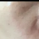 医療脱毛（顔） 新宿Ladies&Gentlemen美容クリニック DAY 0 サムネイル用
