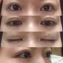 眼瞼下垂（切開） / 上まぶたの脂肪取り 白山クリニック 大分 DAY 29 サムネイル用
